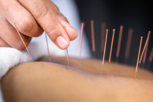 Losing weight with acupuncture